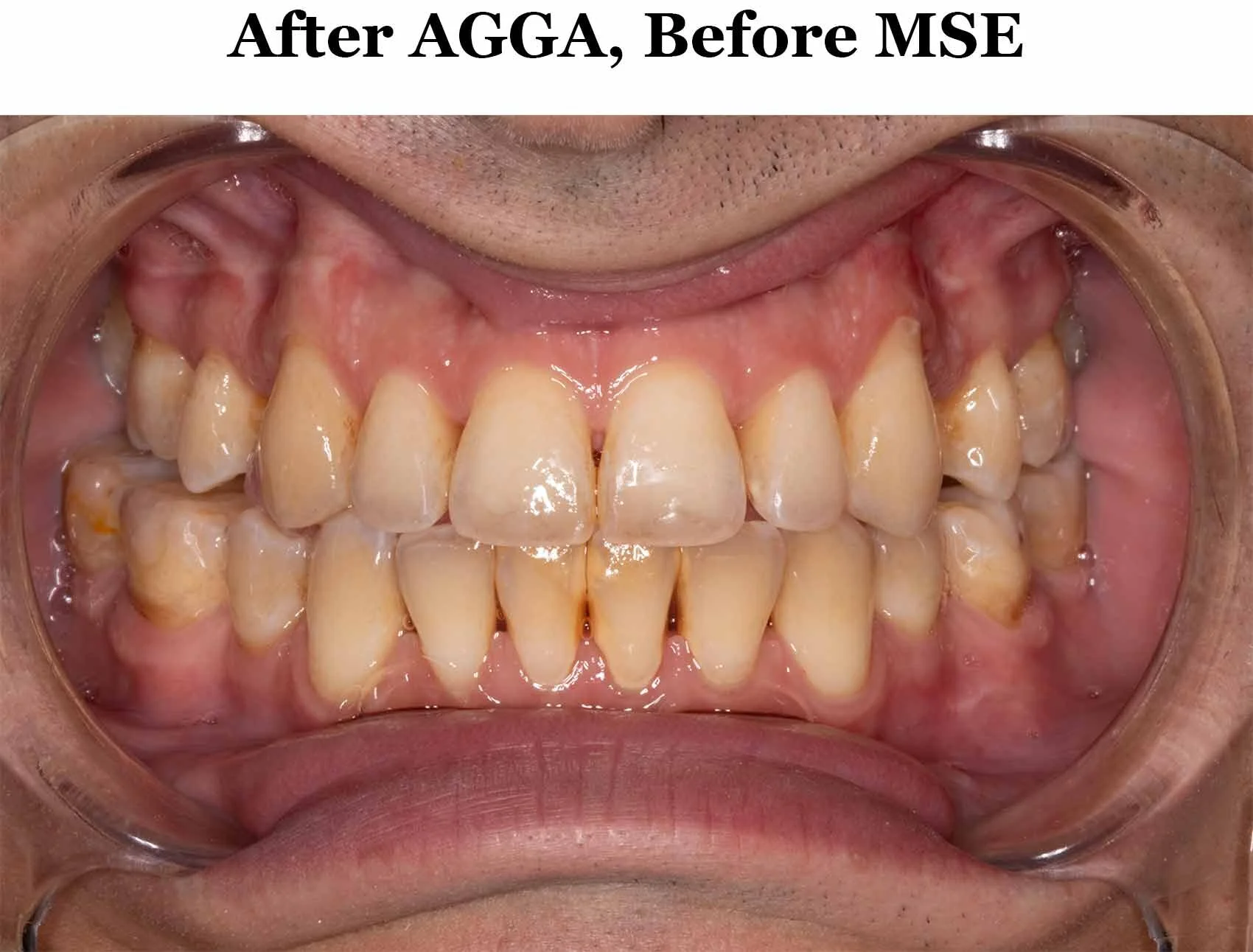 MSE 86 Days, 84 Turns, Expansion Complete — JAWHACKS