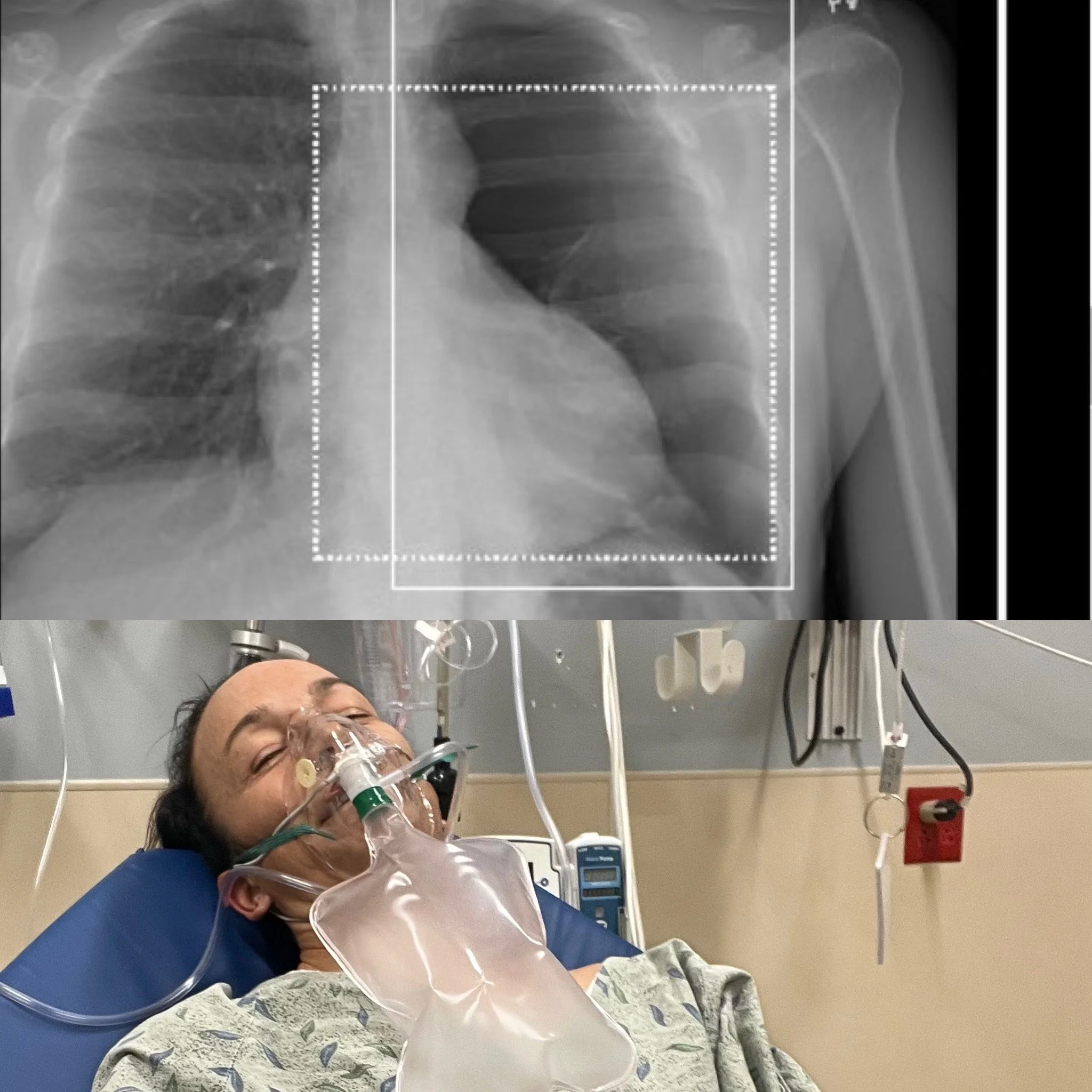 Collapsed Lung and Broken Ribs The Acute Phase Return To Sport