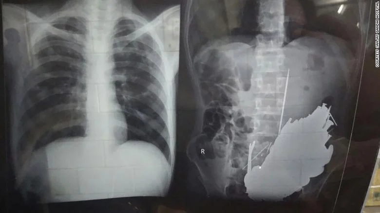 Doctors Find 12 Pounds Of Metal In Man's Stomach
