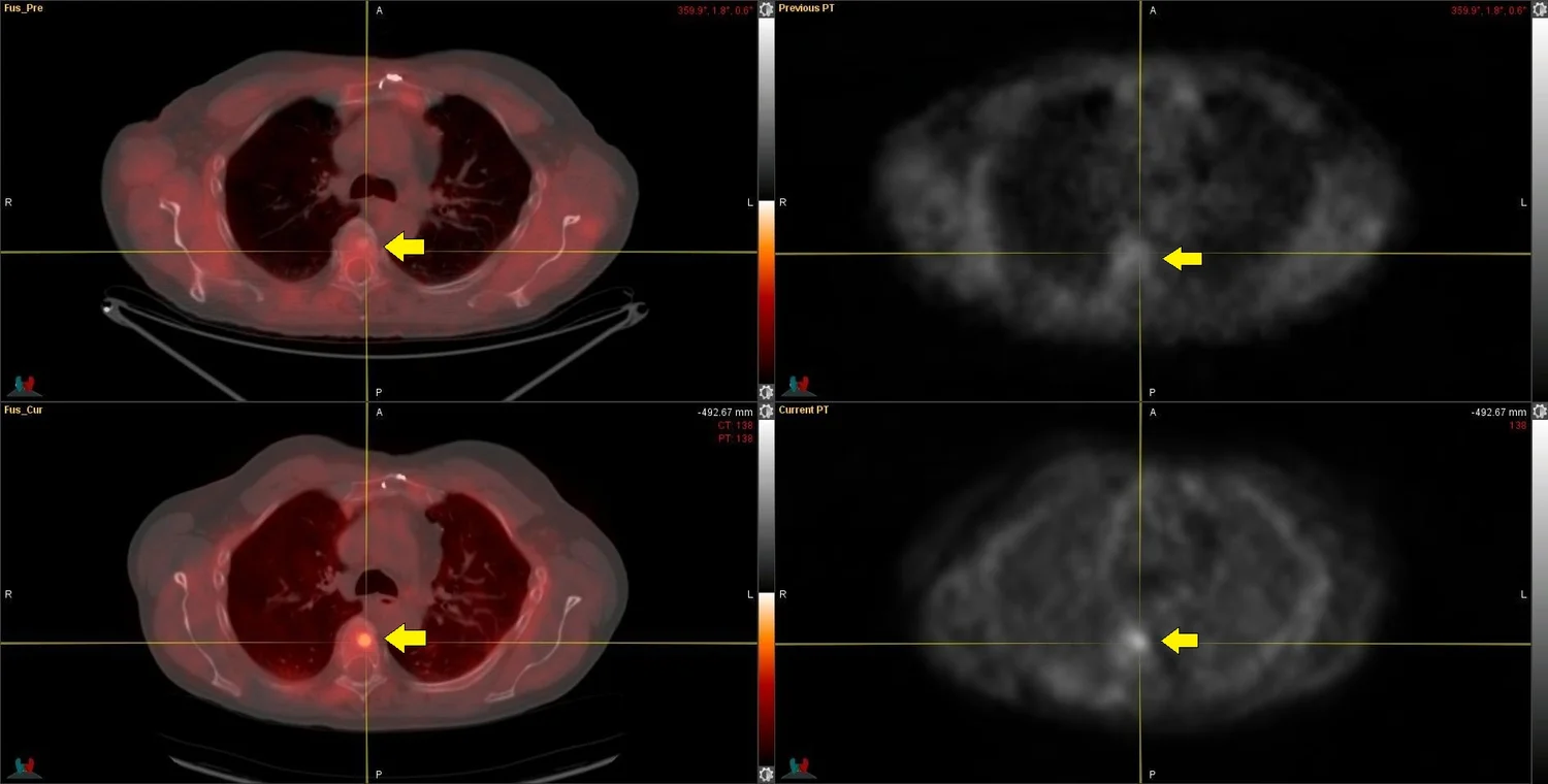 Overview of PET/CT Imaging in Recurrent Prostate Cancer – Current and ...