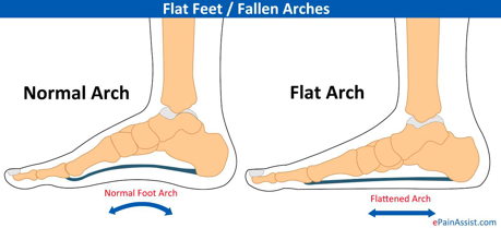 How Can Physical Therapy Help My Plantar Fasciitis? — Physical Therapy ...
