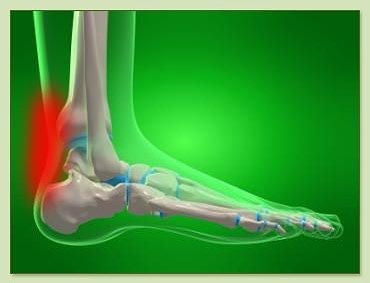 Check out our most recent article on Achilles tendinitis and how PT can help you get rid of it! LINK in BIO! #rehab #evolve #achillestendinitis #sportsrehab #physicaltherapy