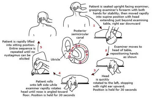 What is BPPV and How Can PT Help it? — Physical Therapy in Brooklyn ...