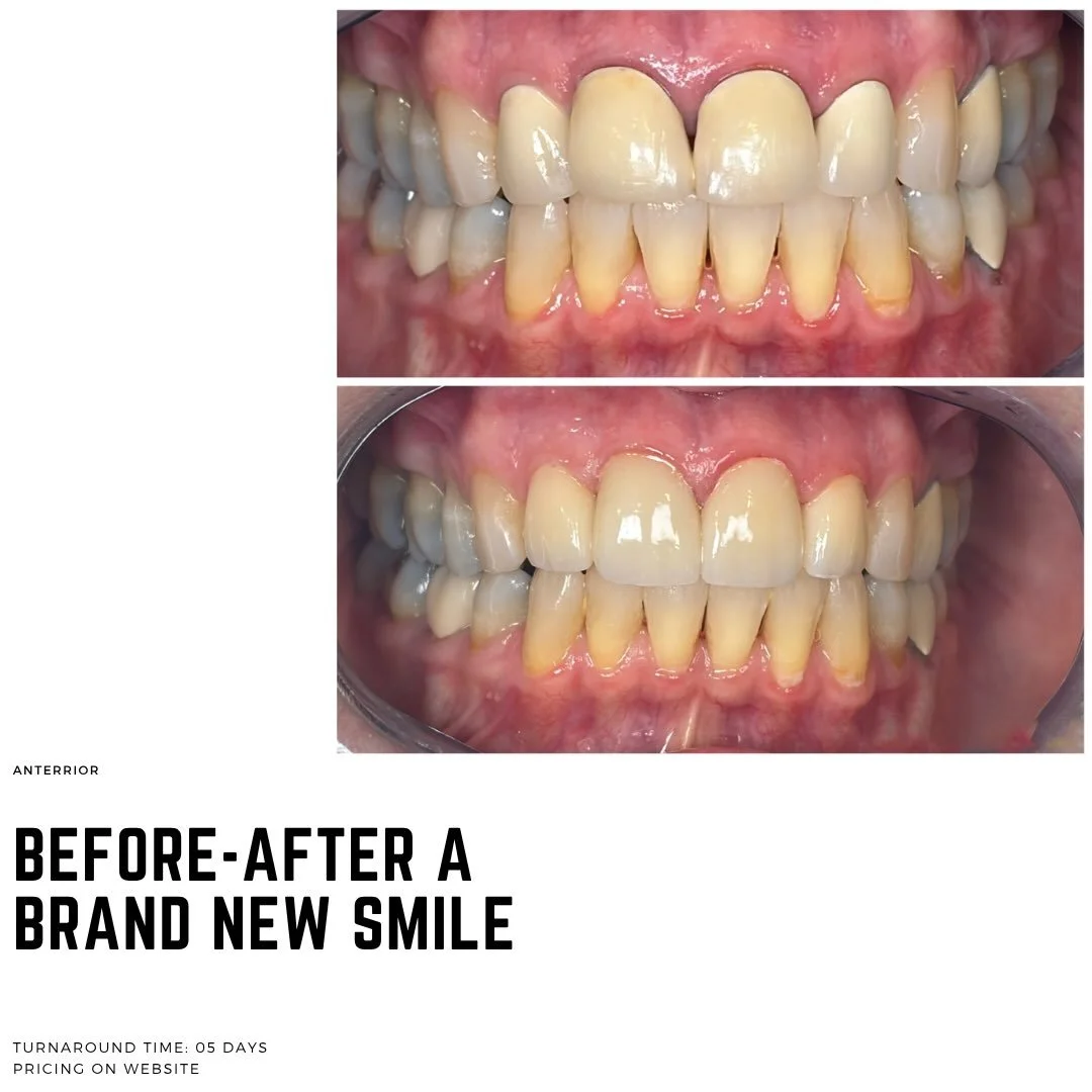 A beautiful before and after ➡️ Just four units makes a huge difference 🤩. Patient wanted a natural shade for a perfect match! 

#dental #dentist #dentistry #smiletransformation #dentallab