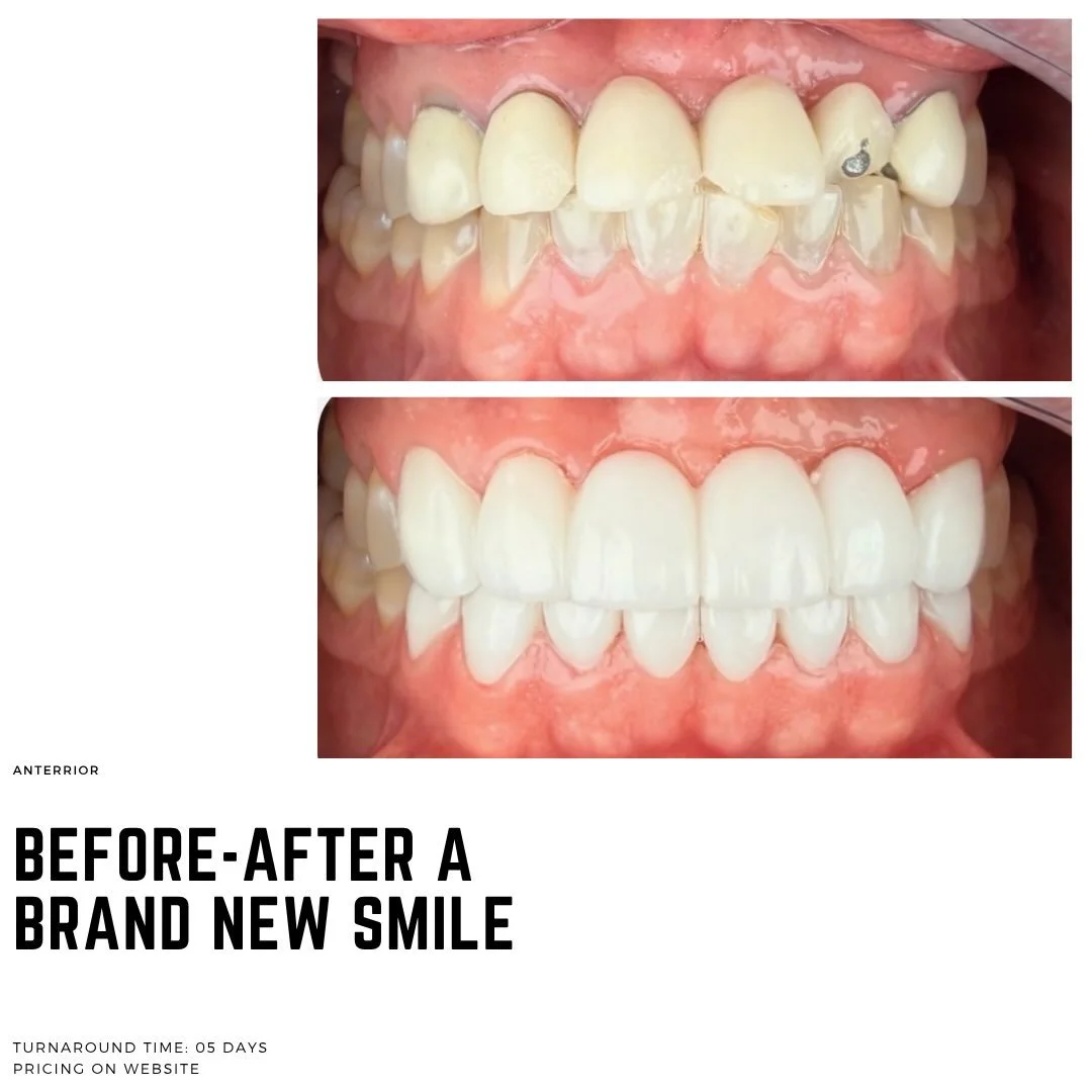 Take a look at this life changing smile transformation by Dr. Jared Kay @jaredkay39 👏✨

#dental #dentist #dentallab #smiletransformation #dentistry