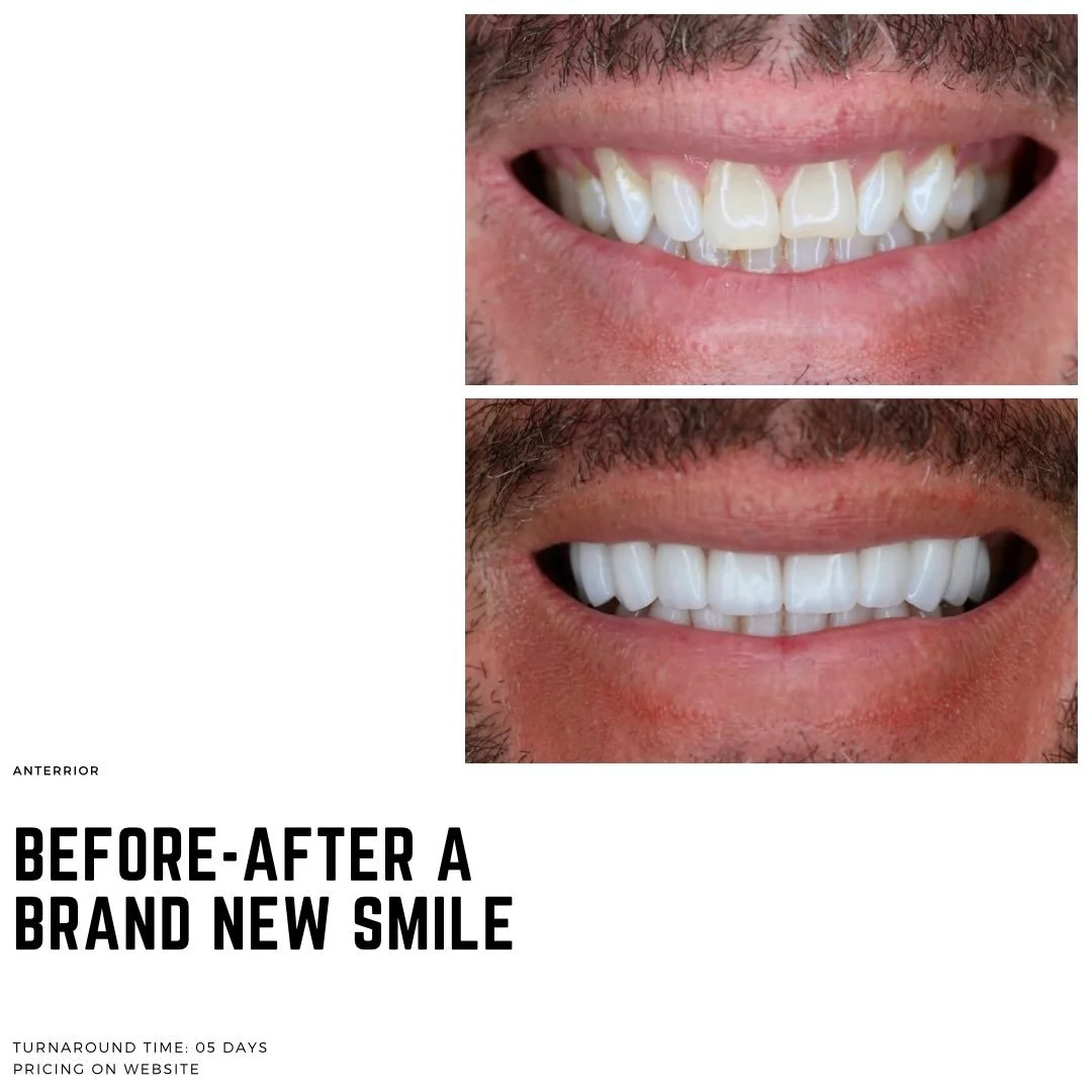 Check out this beautiful smile transformation by Dr. Etemad over at Newport Smile Studio 🦷✨👏 @dr.abraketemad 

#dental #dentist #dentistry #smiletransformation #dentallab