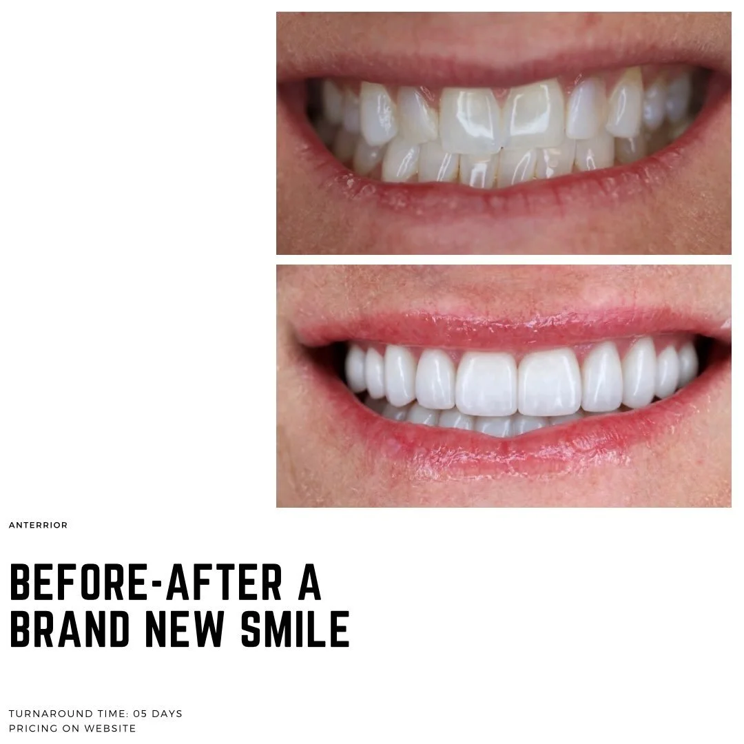 Take a look at this amazing smile transformation by Dr. Etemad over at Newport Smile Studio @dr.abraketemad 🤩👏👏

#dental #dentistry #dentallab #smiletransformation #cosmeticdentistry