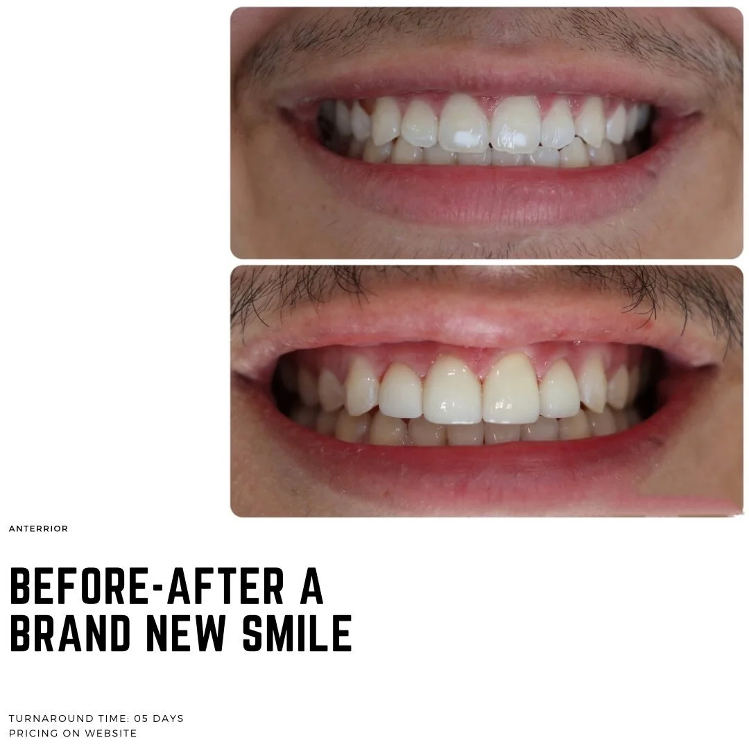 A smile transformation worth sharing ✨🦷 Beautiful results by Schuchart Dentistry in San Antonio, TX! 🤍 @schuchartdentistry 

#dental #dentistry #smiletransformation #costmeticdentistry #dentist