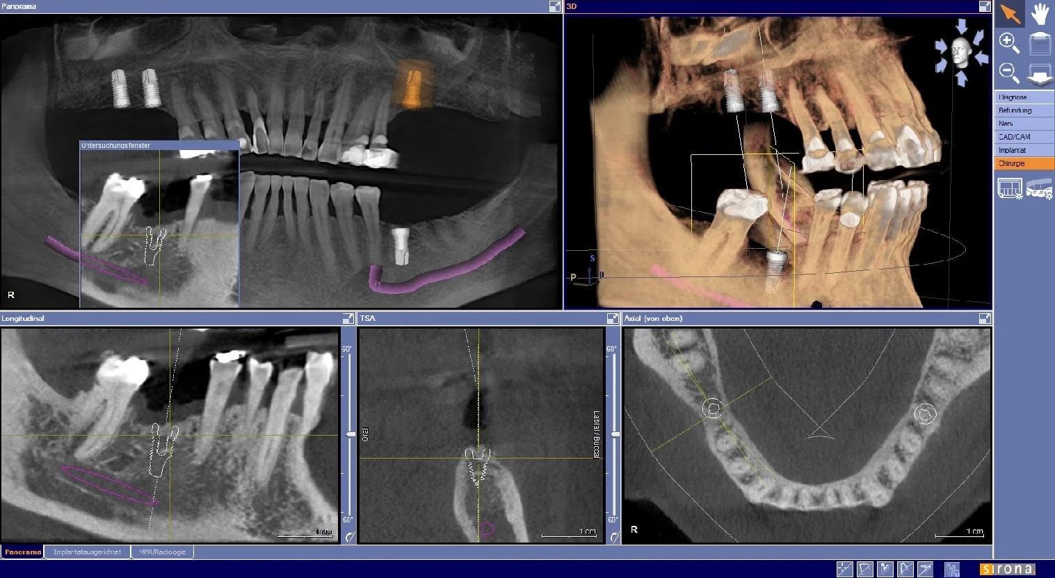 3-D imaging provides mapping of nerves, bone, and teeth for unprecedented levels of planning detail