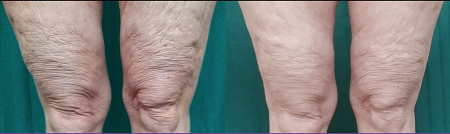 Before-and-After-Trusculpt-iD.png