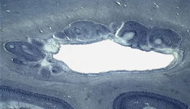 Sometimes migratory cells get stuck in locations where they should not be present. In this photograph they are present as nodules abutting the central cavities (ventricles) of the brain. These cellular agglomerations are usually foci of seizures. (Image courtesy of Dr. Manuel Casanova)