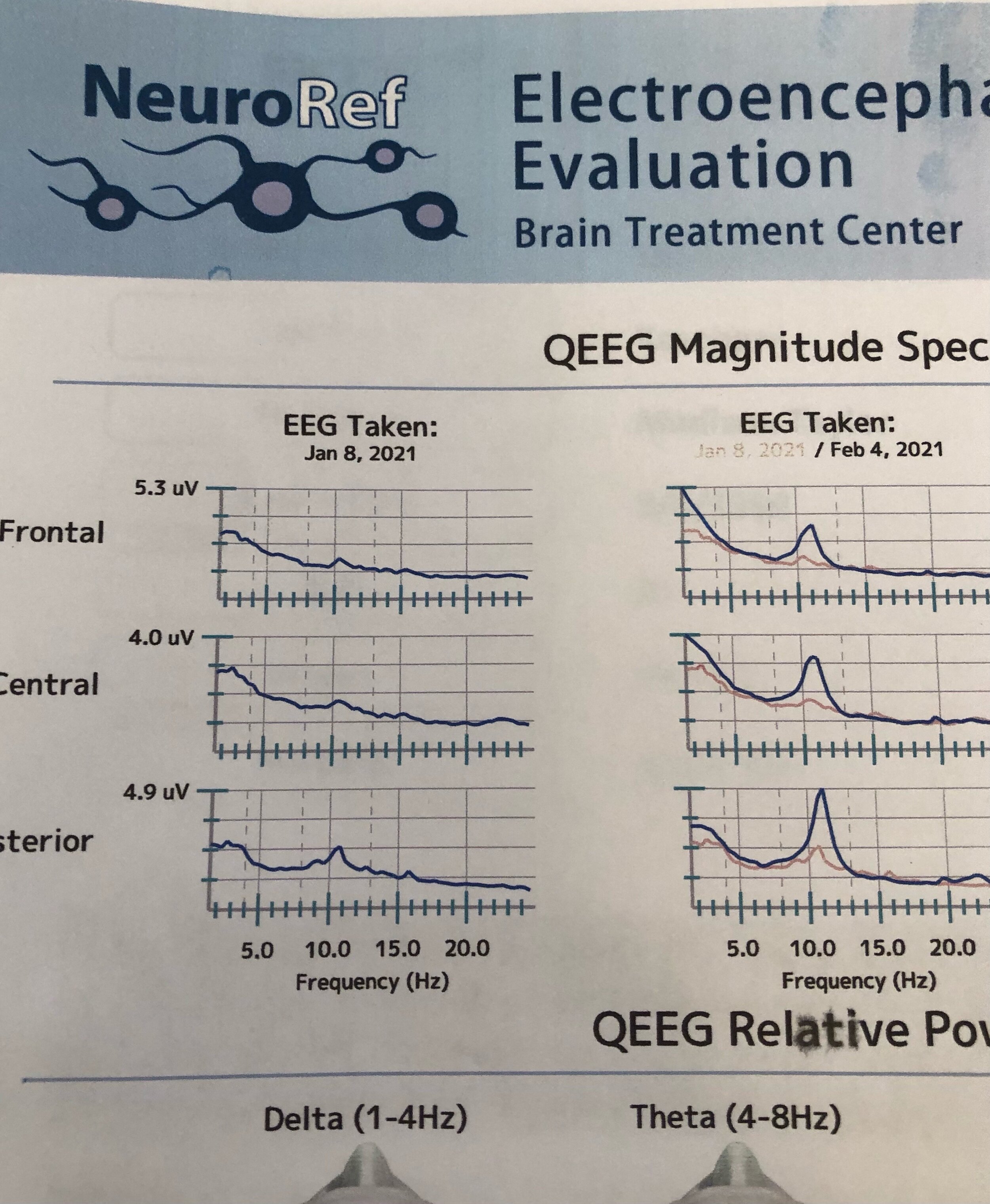 Changes in Madison’s EEG seen after a month of treatments.