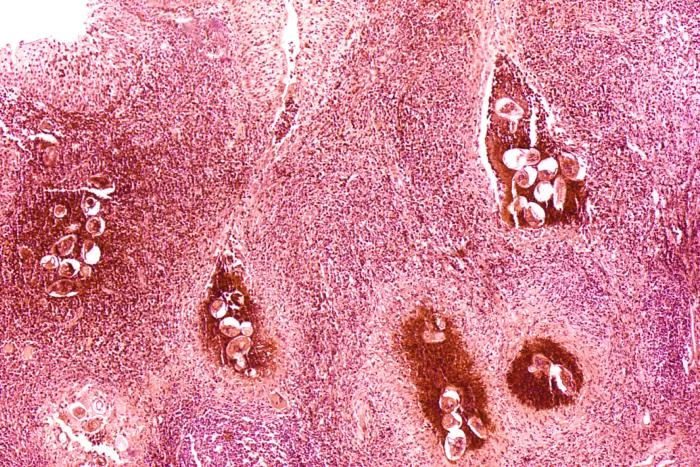 Eggs of Schistosoma haematobium surrounded by intense infiltrates of eosinophils and other inflammatory cells. CDC/Dr. Edwin P. Ewing, Jr., 1973.