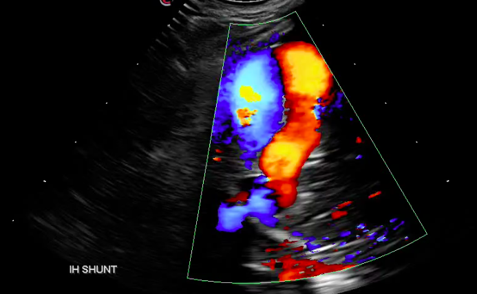 Abdominal Ultrasound