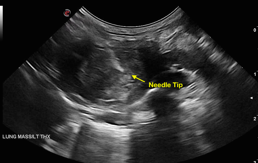 U/S Guided Fine-needle Biopsy