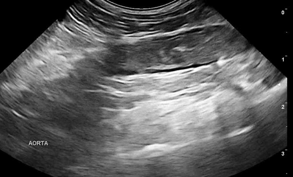 An image of the left adrenal displaying the typical ultrasonographic appearance of pituitary dependent hyperadrenocorticism.