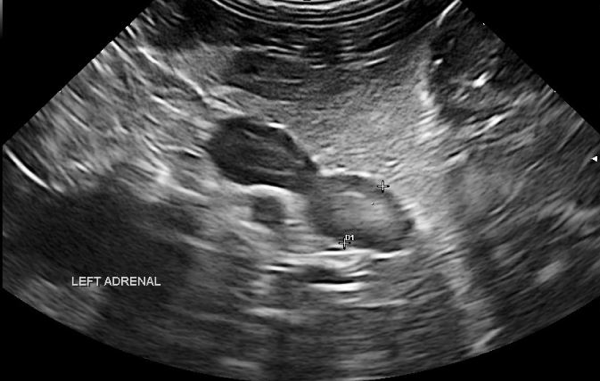 An image of the left adrenal displaying the typical ultrasonographic appearance of pituitary dependent hyperadrenocorticism.