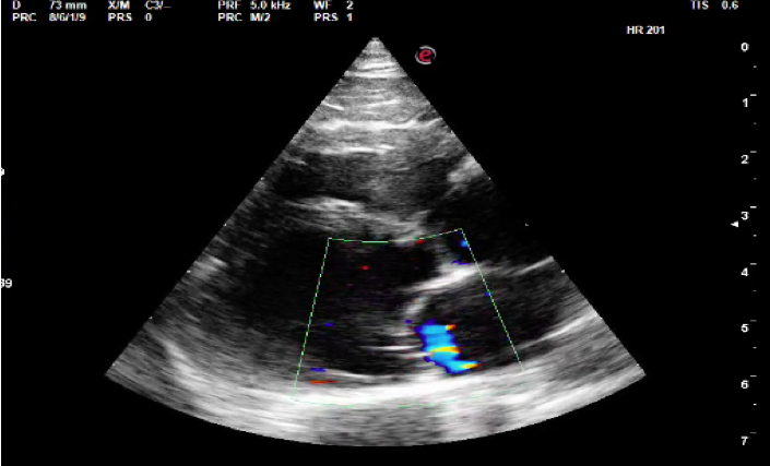 Color flow image of the mitral regurgitation jet entering the left atrium.