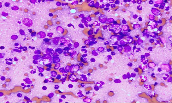 Numerous neutrophils and macrophages surrounding several small lymphocytes and few plasma cells.