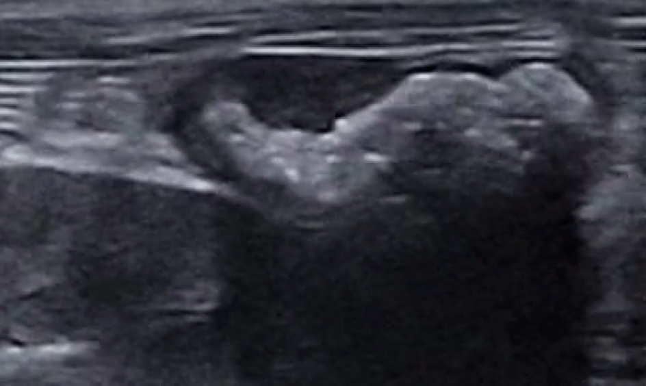 Another segment of proximal colon with asymmetric thickening. Complete loss of normal wall layering distinction is observed on the thickened left colonic wall, compared to the normal “tiger striped” appearance of the right.