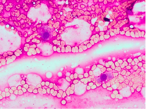 Cytology interpretation and image provided by Casey J. LeBlanc, DVM, PhD, DACVP, Eastern VetPath
