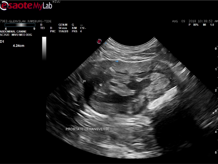 This image demonstrates the severely irregular echotexture of the prostate.