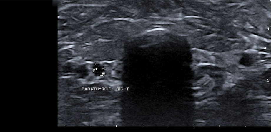 A transverse view of the parathyroid nodule located in the right thyroid gland. The heavily shadowing structure is a normal air-filled trachea.