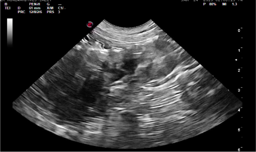 The left kidney of this patient is most consistent with renal dystrophy. Poor cortical medullary distinction is present. Similar changes were also seen in the right kidney.