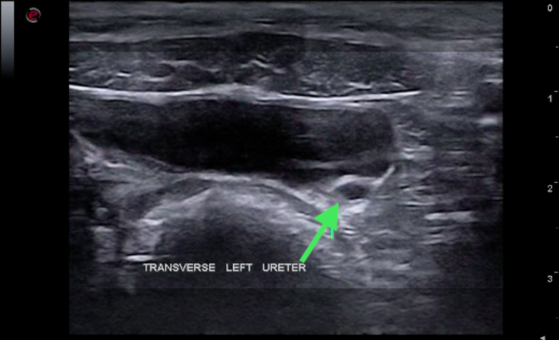 A transverse view of the left dilated ureter (green arrow) within the dorsal bladder wall. The urinary bladder is seen directly ventral to the round colon.