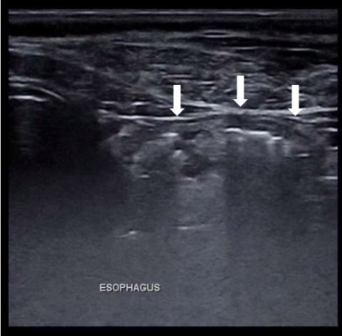 Image 1: Transverse view of the dilated esophagus (arrows) contained air and anechoic fluid obtained with a high frequency transducer.