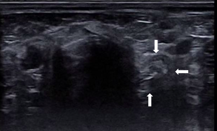 Image 2: transverse view of a normal esophagus (arrow) with appropriate tone and empty lumen located to the left of the trachea.