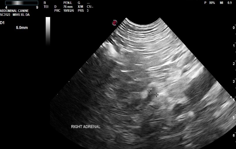 The normal appearing contralateral right adrenal gland.