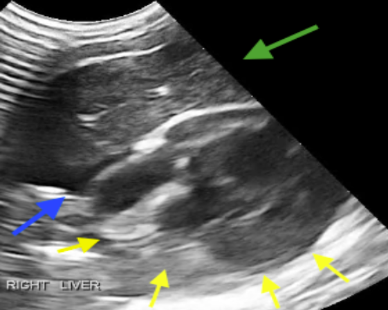 Transverse view of the right lateral thorax. Pleural effusion is present (blue arrow). A portion of the right liver (green arrow) is visualized ventral to the heart (yellow arrows).