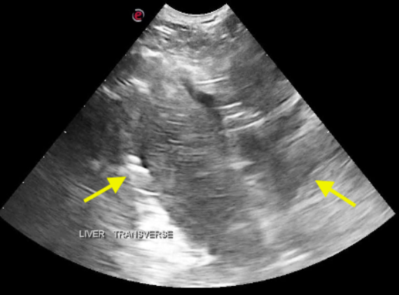 Transverse view of the liver and diaphragm. The margin of the diaphragm is disrupted (yellow arrows).