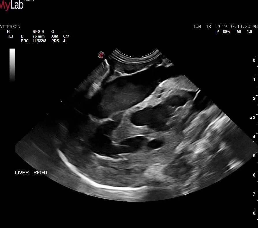 Severely dilated and converging vessels in the left liver.