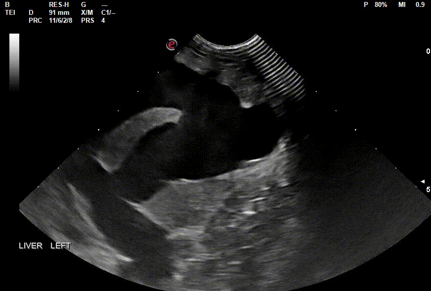 "Smoke" noted throughout the dilated liver vasculature.