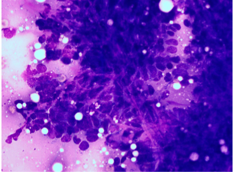 Image: A dense aggregate of polygonal cells with large oval nuclei.