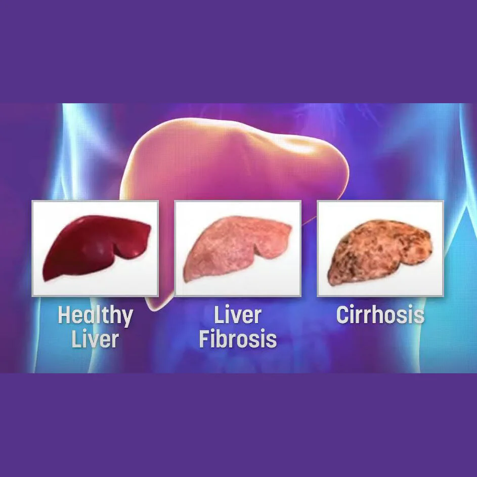 What You Need to Know About Hepatitis C