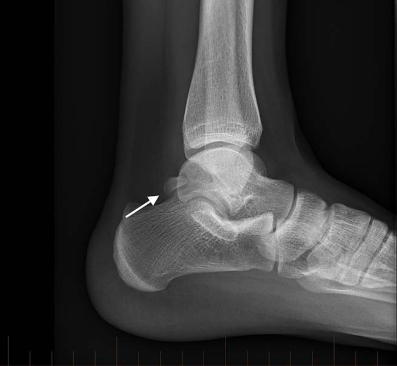 Posterior Ankle Impingement — Dynamic Physio Therapy | Naples, FL ...