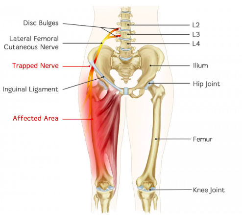 What Causes a Pinched Nerve in the Hip & How to Treat It?