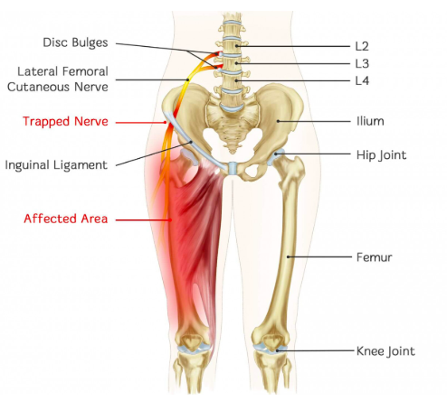 Lower Extremity Pain – Trapped Femoral-Sciatica Nerve — Therapi Tylino