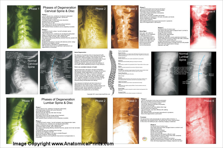 SpinalDegenerationCL24x36.jpg