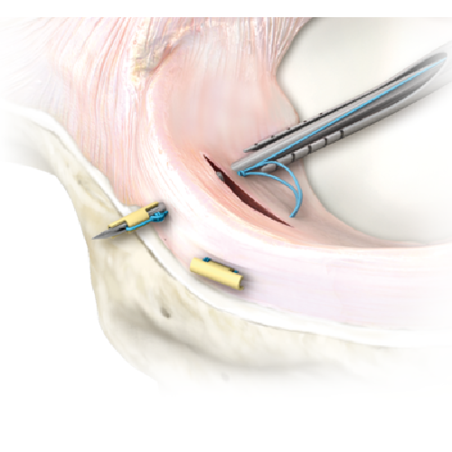 meniscal+fastfix.png