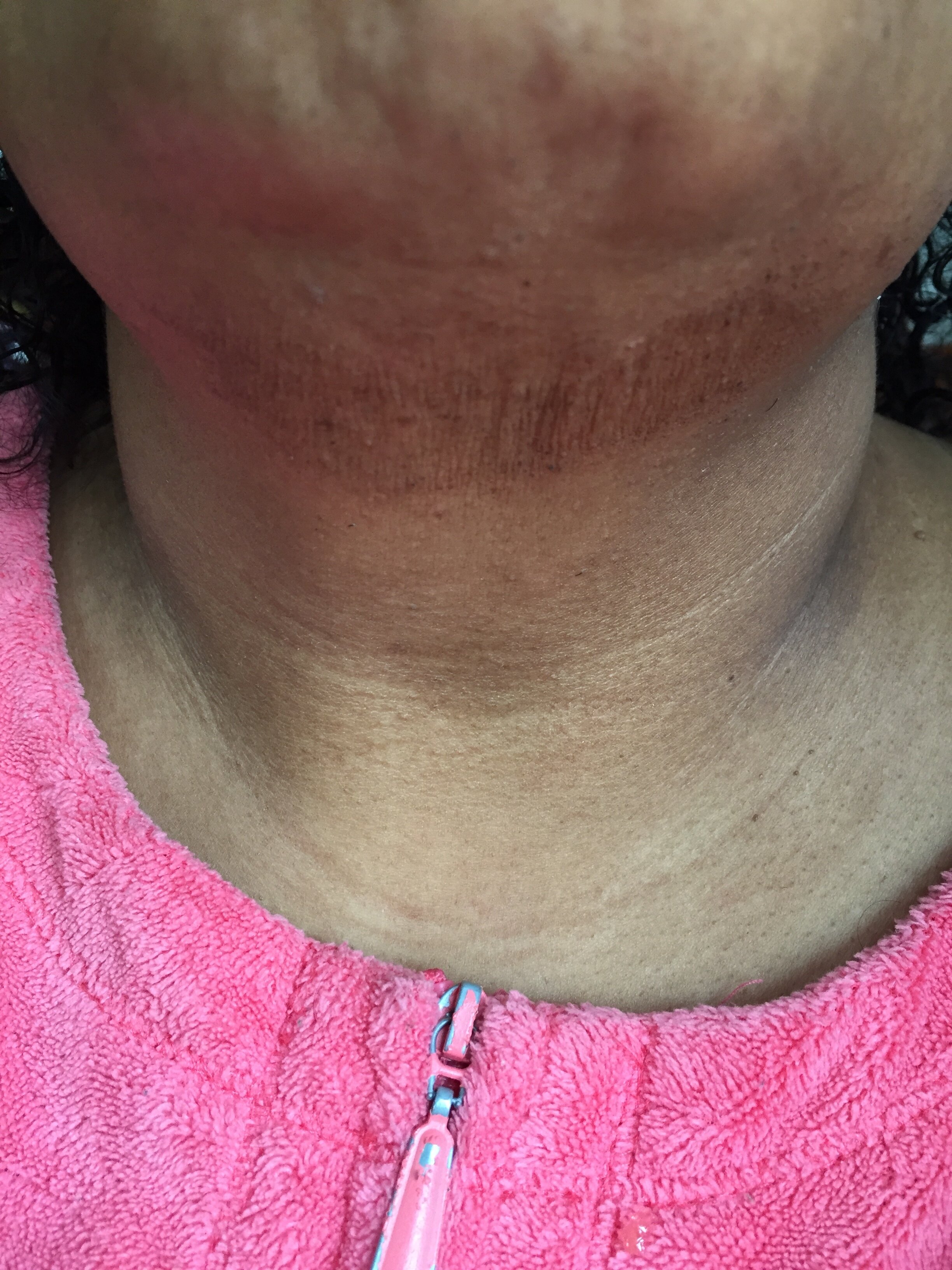 WHY I CREATED SCAR OIL!
