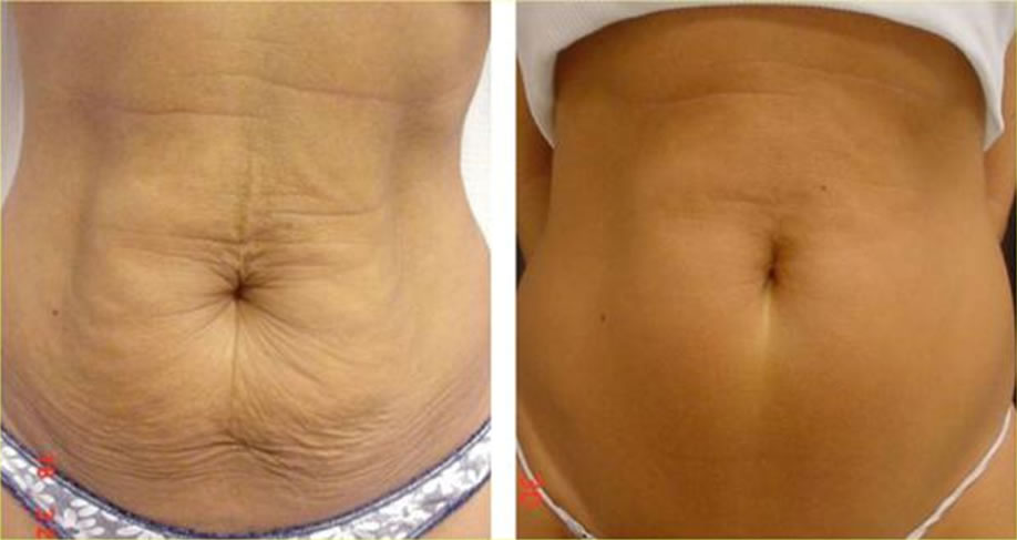 non surgical skin tightening stomach near me