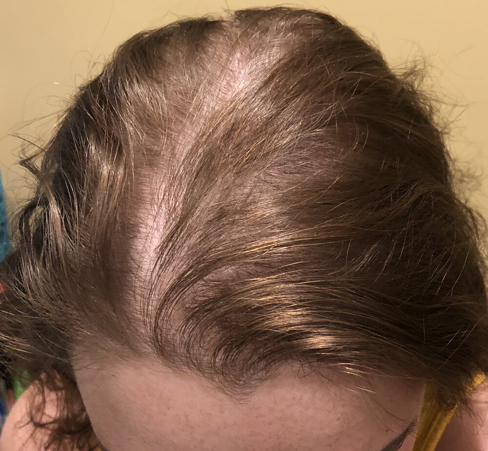 Women's Hair Loss Treatment Solutions in NJ — Mancuso Salon & Spa