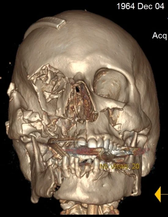 Photo: 3D image from Harborview Medical Center
