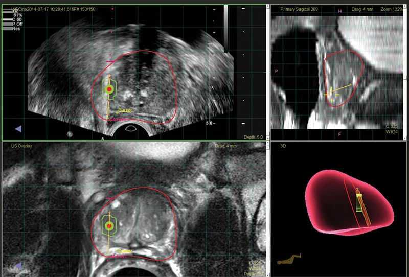 biopsy.jpg