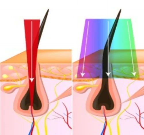 LaserVsIPL_diagram-1 (4).jpg