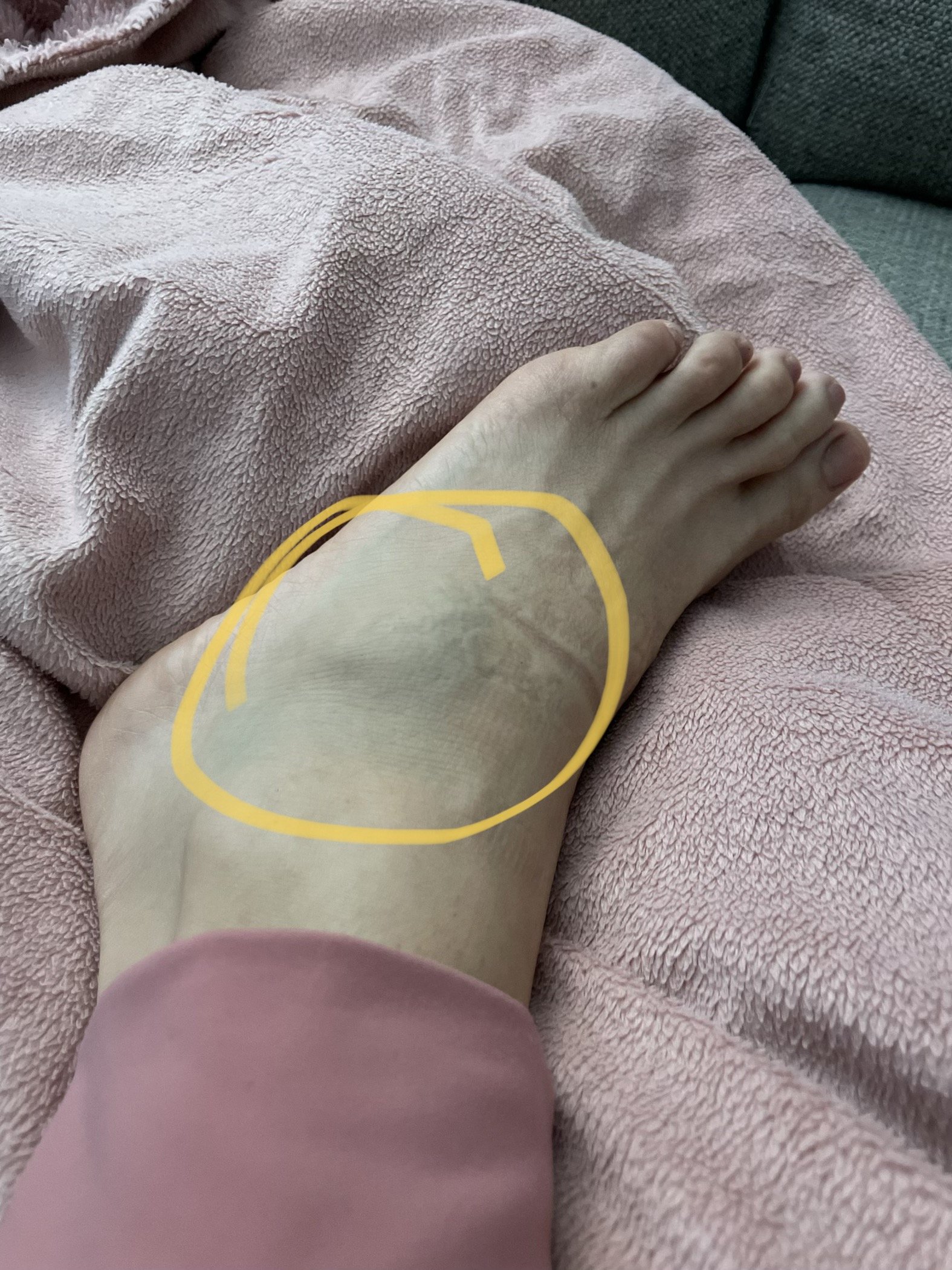 Day 1 - Swollen Foot